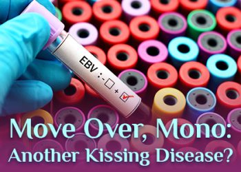 Sugar Hill dentists, Dr. Jonathan Chang and Dr. Ruby Truong at Sweet City Smiles talk about a kissing disease you might be less familiar with than mononucleosis.